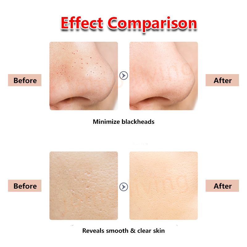 JOMO Ultrasonic Exfoliating Ion Facial Scrubber Remove Impurities Face Cleaning Machine